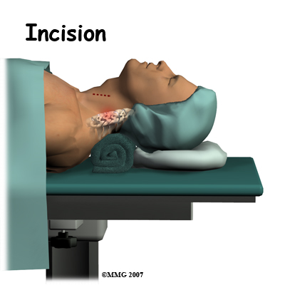 cervical_ADR_surgery01