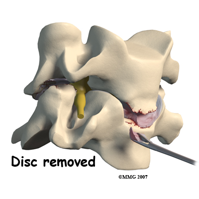 cervical_ADR_surgery02