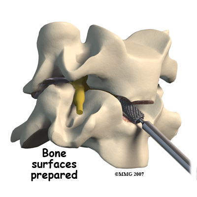 cervical_ADR_surgery03