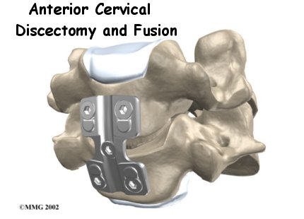 cervical_antdisc_intro01