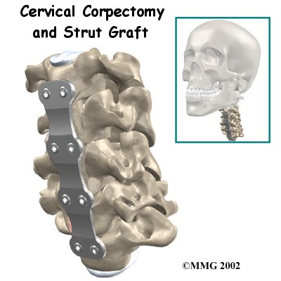 cervical_corpectomy_strut_intro01