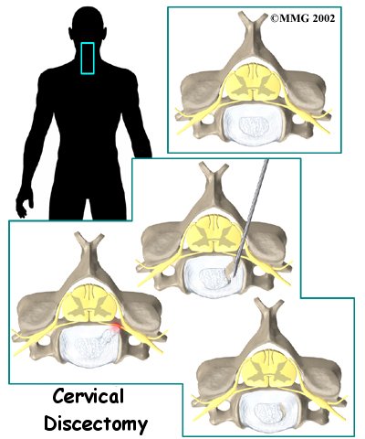 cervical_discectomy_intro01