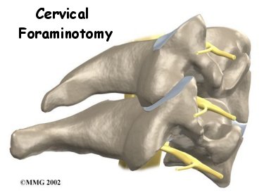 cervical_foraminotomy_intro01