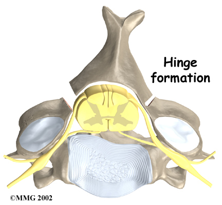 cervical_laminectomy_surgery01
