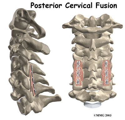cervical_postfuse_intro01