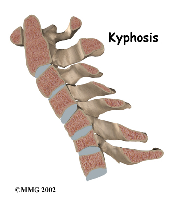 cervical_postfuse_rationale02