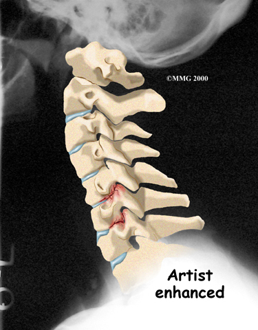 cervical_radiculopathy_diagnosis01_001