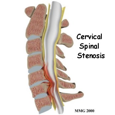cervical_stenosis_intro01