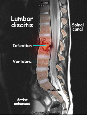 child_back_pain_MRI_color