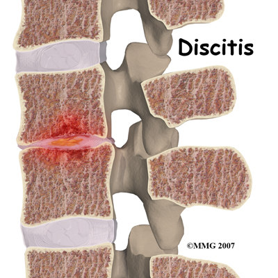 child_back_pain_discitis