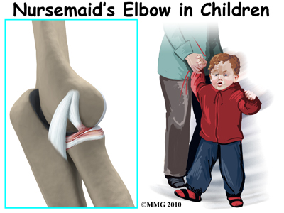 child_elbow_nursemaids_intro01