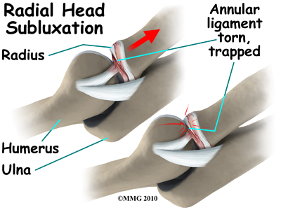 child_elbow_nursemaids_radialhead_sublux