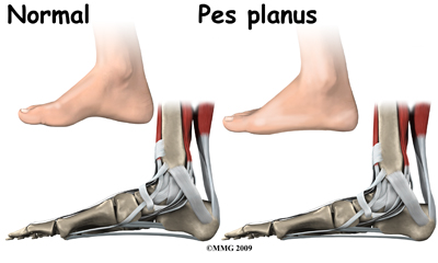 child_flatfoot_causes01
