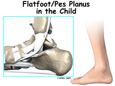 child_flatfoot_intro01