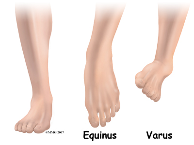 child_foot_clubfoot_anatomy03