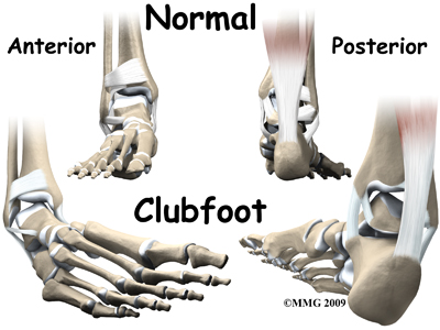 child_foot_clubfoot_causes01