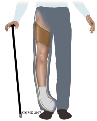 child_foot_clubfoot_symptoms01