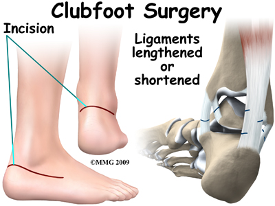 child_foot_clubfoot_treatment03