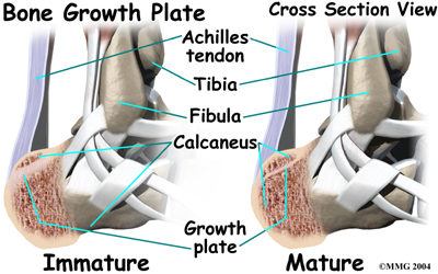 child_foot_severs_causes02