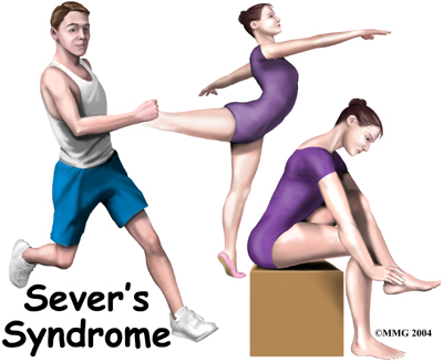 child_foot_severs_intro01