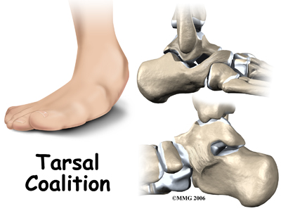 child_foot_tarsalco_intro01