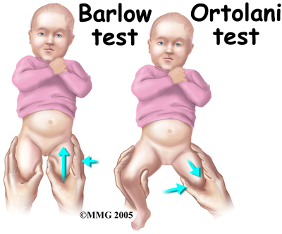 child_hip_devel_dysp_diagnosis01