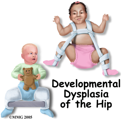 child_hip_devel_dysp_intro01