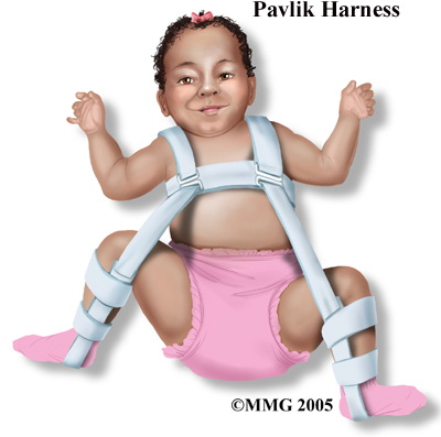 child_hip_devel_dysp_treatment01