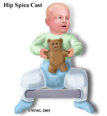 child_hip_devel_dysp_treatment02