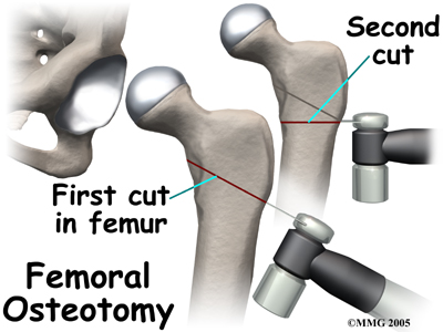 child_hip_devel_dysp_treatment03