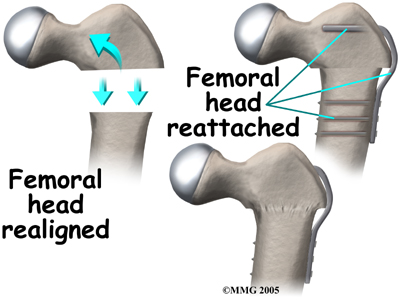 child_hip_devel_dysp_treatment04