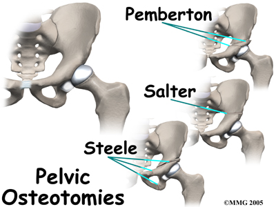 child_hip_devel_dysp_treatment05