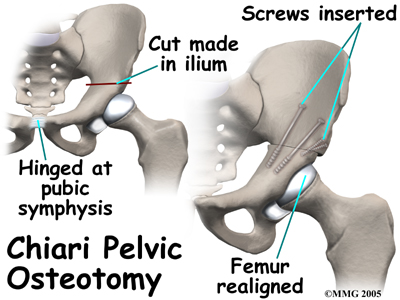 child_hip_devel_dysp_treatment06