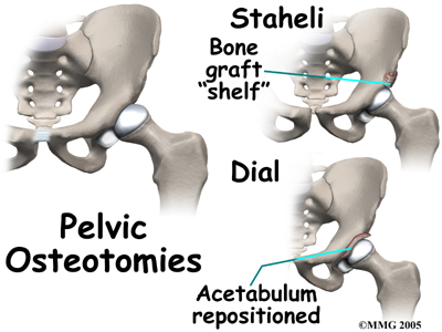 child_hip_devel_dysp_treatment07
