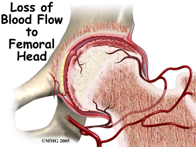 child_hip_perthes_causes01