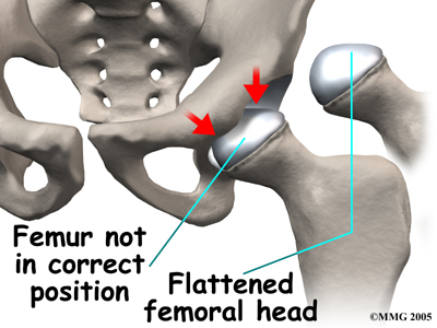 child_hip_perthes_causes02