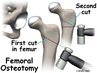 child_hip_perthes_surgery01