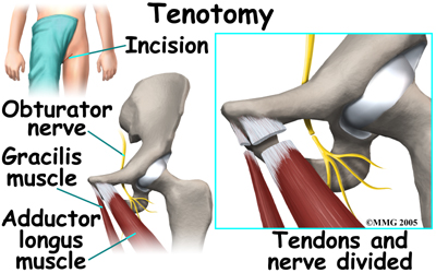 child_hip_perthes_tenotomy01