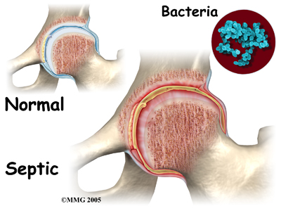 child_hip_septic_causes01