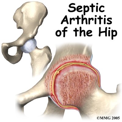 child_hip_septic_intro01