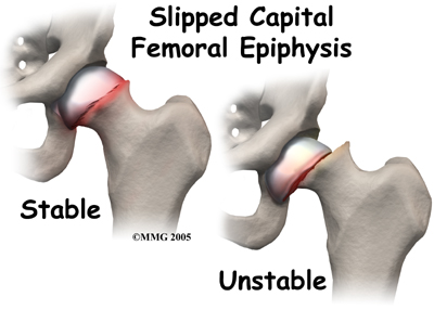 child_hip_slipped_cfe_causes01
