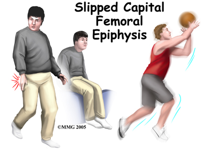 child_hip_slipped_cfe_intro01