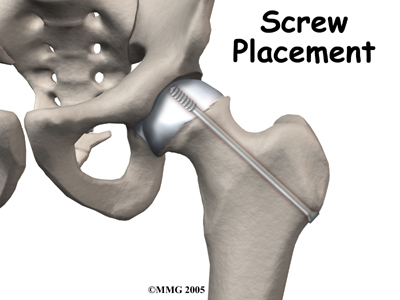 child_hip_slipped_cfe_surgery01
