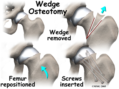 child_hip_slipped_cfe_surgery02