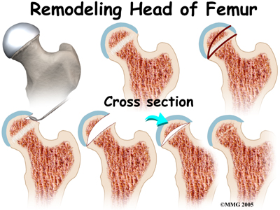 child_hip_slipped_cfe_surgery04