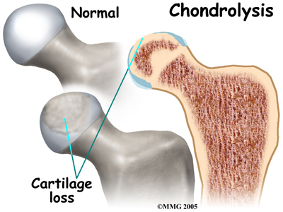 child_hip_slipped_cfe_symptoms02