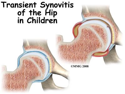 child_hip_trans_synovitis_intro01