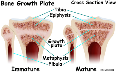 child_knee_blounts_anatomy04