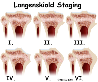 child_knee_blounts_diagnosis01