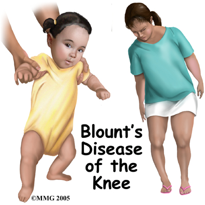 child_knee_blounts_intro01
